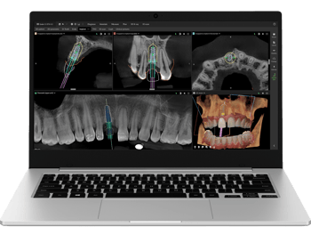 DTX Studio Clinic_Implant planning